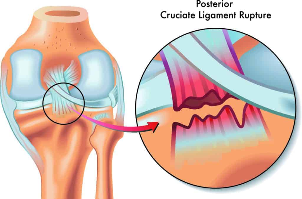 Posterior Cruciate Ligament PCL reconstruction