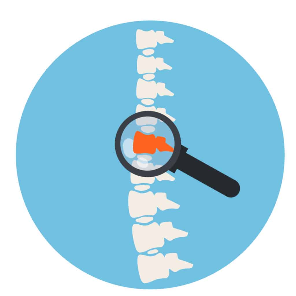 What Is Arthritis Of The Spine