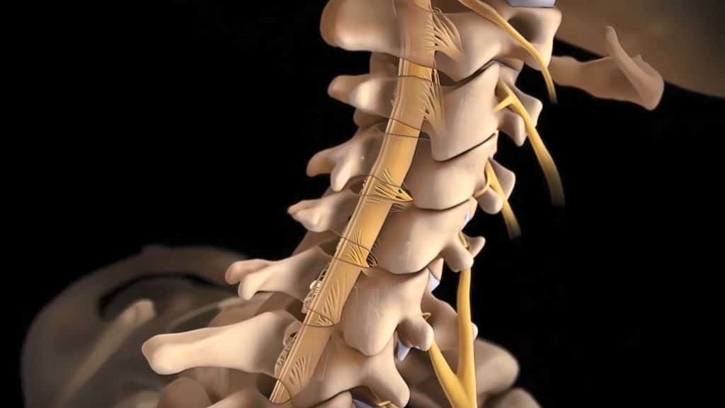 Human spine with nerve roots showing cervical spinal stenosis