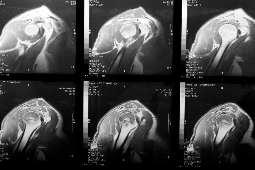 Surgical Options for Rotator Cuff Injuries