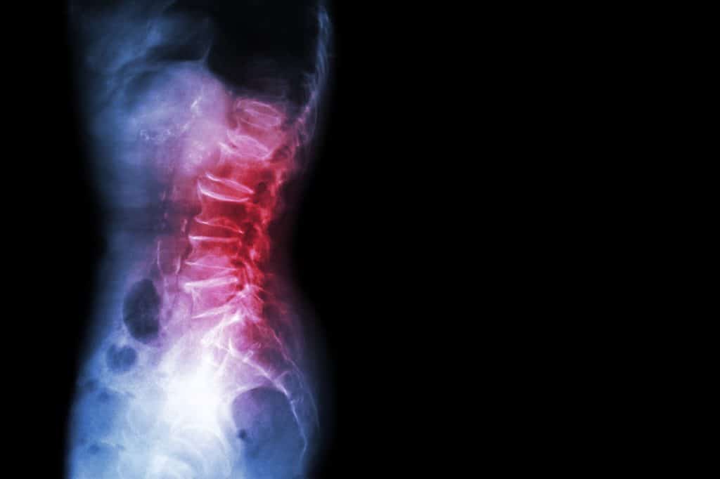 5 Reasons Why You Should Not Rush Into Back Surgery - lowbackxray 94223549