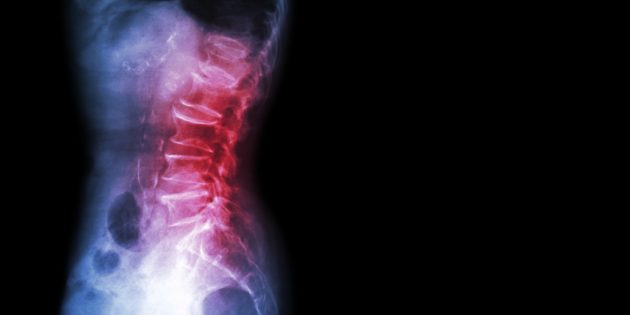 5 Reasons Why You Should Not Rush Into Back Surgery - lowbackxray 94223549