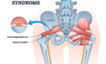 Piriformis syndrome and sciatic nerve compression pain cause outline diagram.