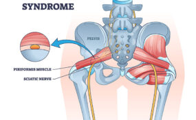 Piriformis syndrome and sciatic nerve compression pain cause outline diagram.