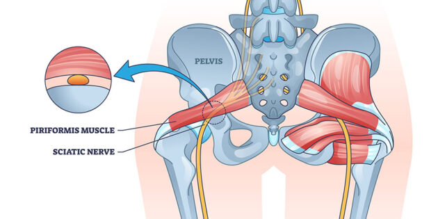 Piriformis syndrome and sciatic nerve compression pain cause outline diagram.