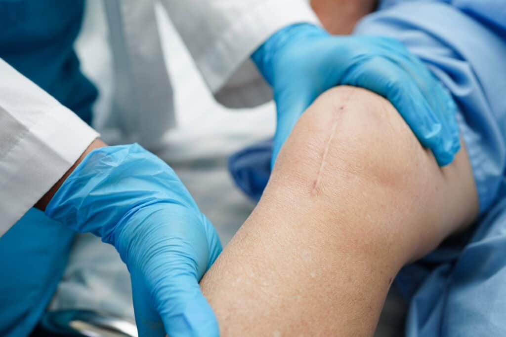 Why Common Knee Surgery May Cause More Harm Than Good - vecteezy asian elderly woman patient with scar knee replacement 47929042