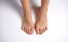 woman with white swollen feet
