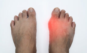 Big toe joint swollen and red from a gout flare-up