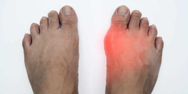 Big toe joint swollen and red from a gout flare-up