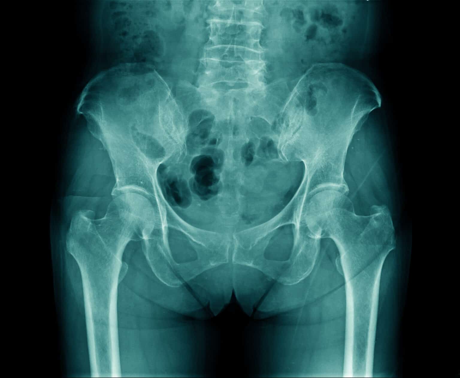 thigh-pain-after-hip-replacement-causes-solutions-and-tips