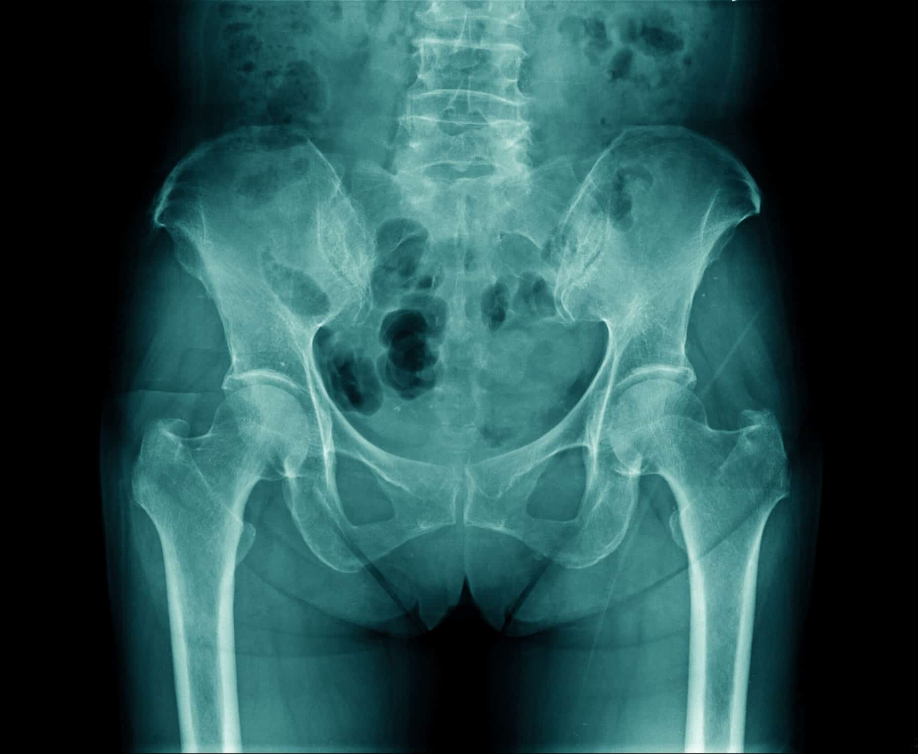 Thigh Pain After Hip Replacement Causes, Solutions, and Tips Intecore Physical Therapy